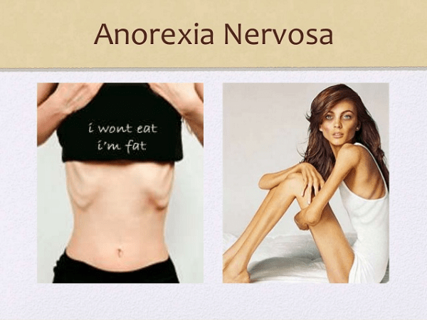 Anorexia Nervosa Là Gì
