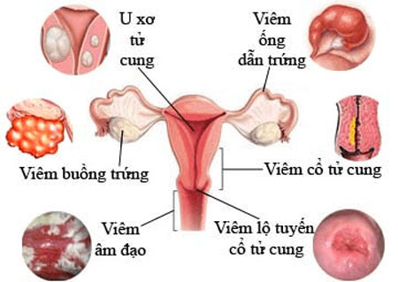 Bệnh Con Gái