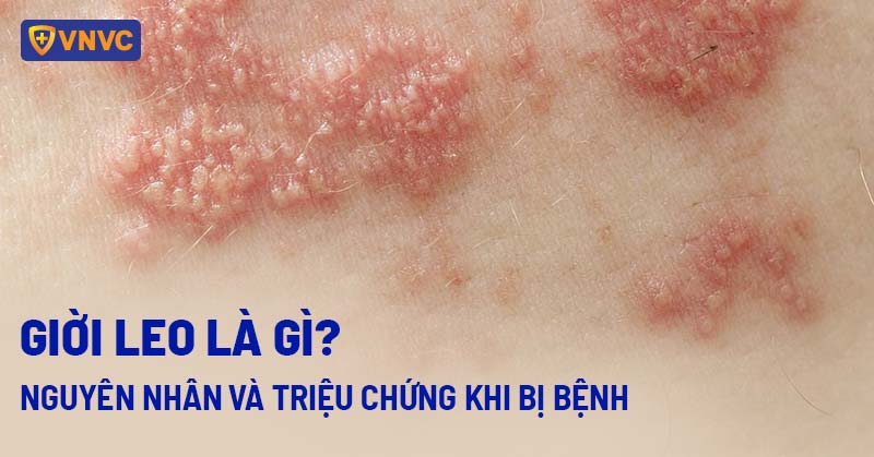 Bệnh Dây Leo