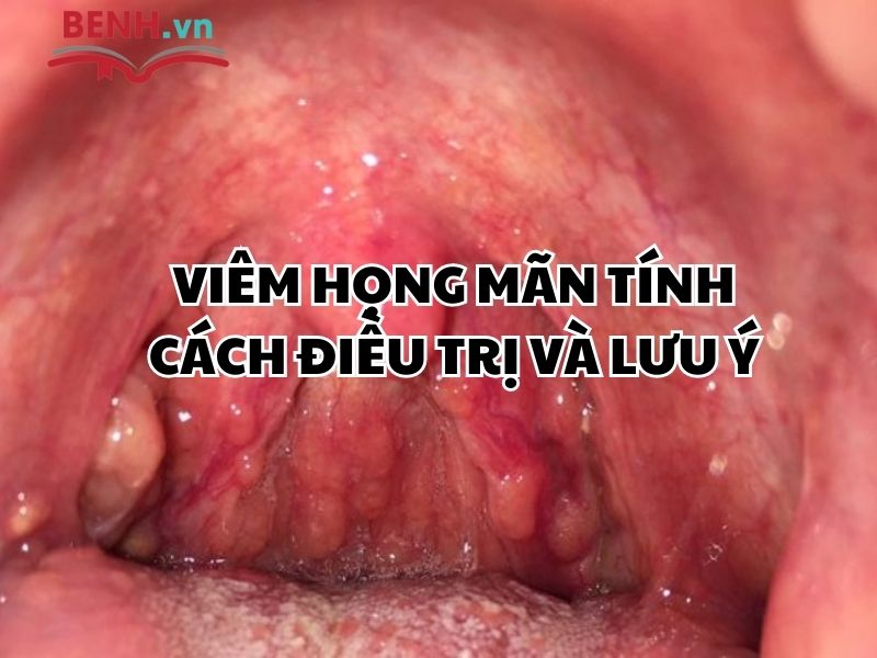Cách Chữa Viêm Họng Mãn Tính