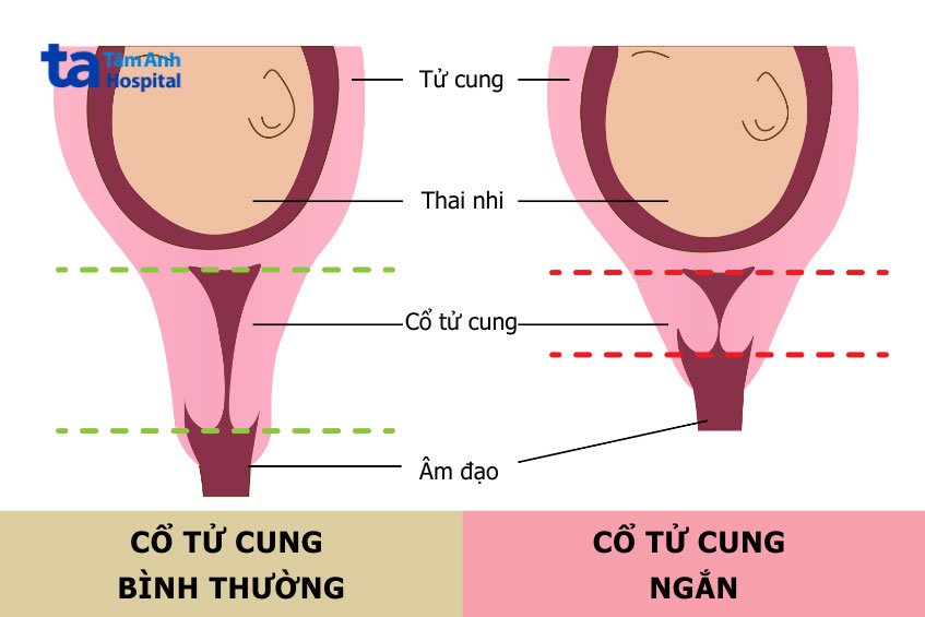 Cổ Tử Cung Nhỏ