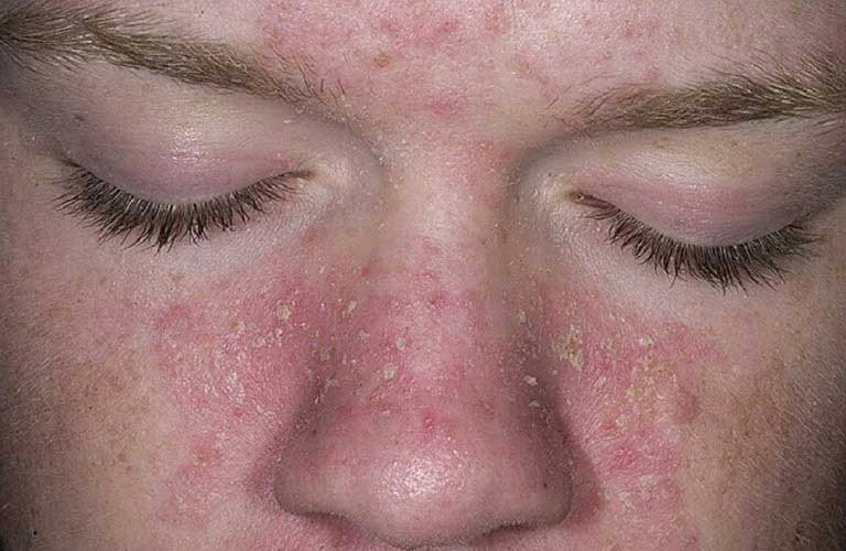 điều Trị Viêm Da Dầu