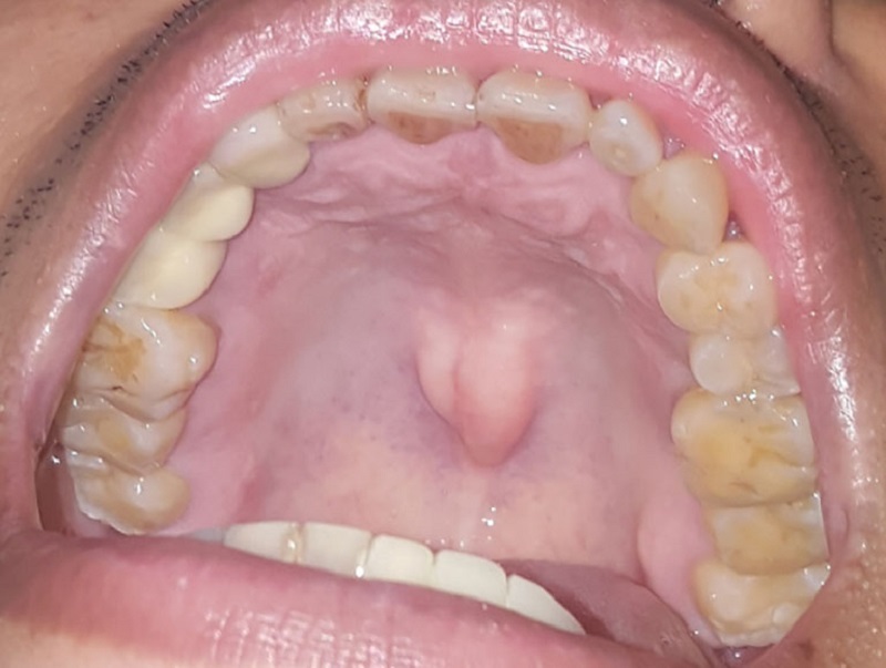 Hàm Trên Nổi Cục