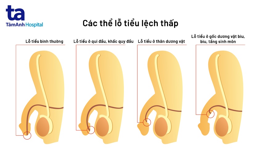 Lỗ Tiểu đóng Thấp
