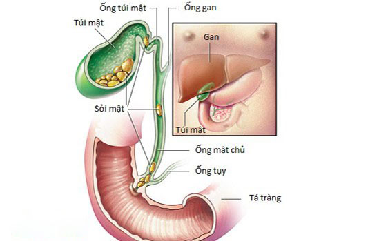 Nguyên Nhân Bị Sỏi Túi Mật