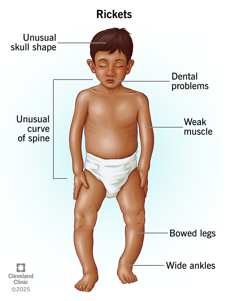 Rickets Là Gì