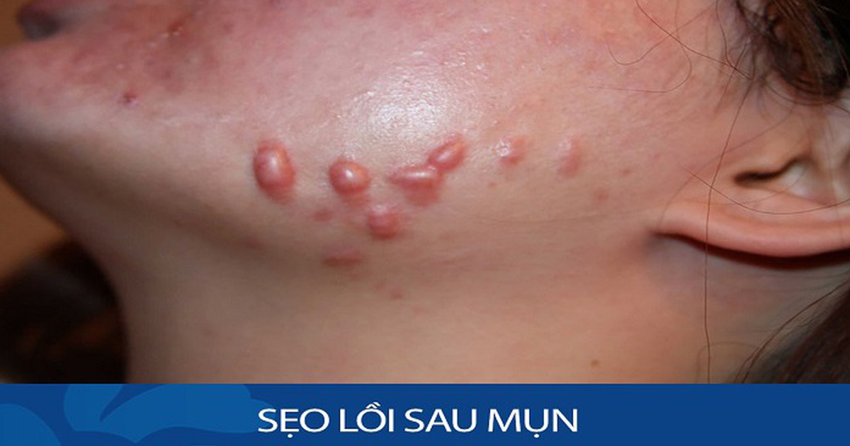 Trị Sẹo Mụn Lồi