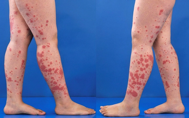 Viêm Mạch Máu ở Chân