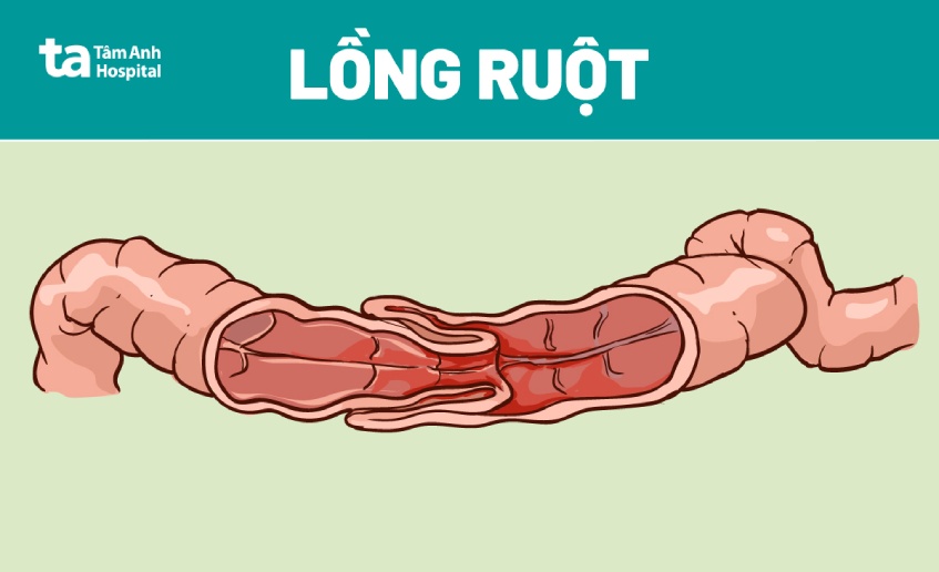 Bệnh Lồng Ruột