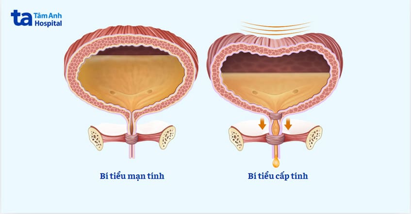 Bị Bí Tiểu ở Nữ Giới
