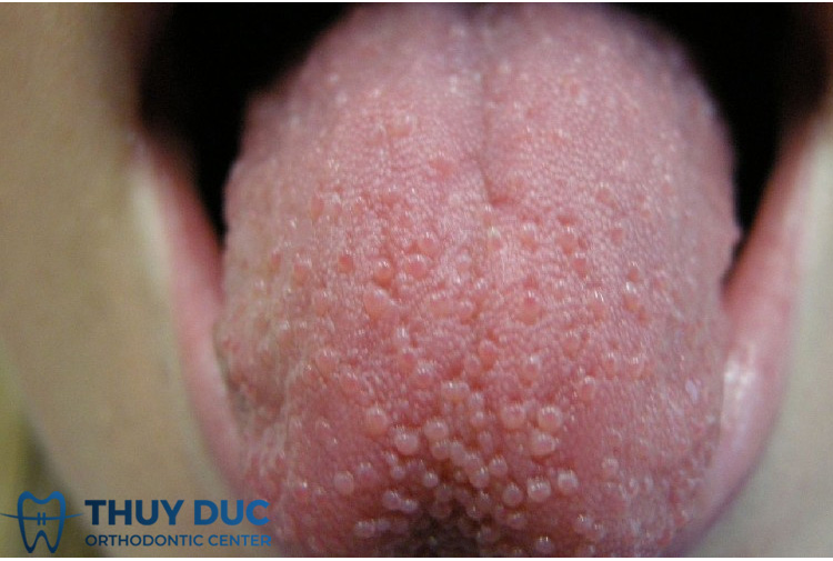 Bị Viêm Lưỡi