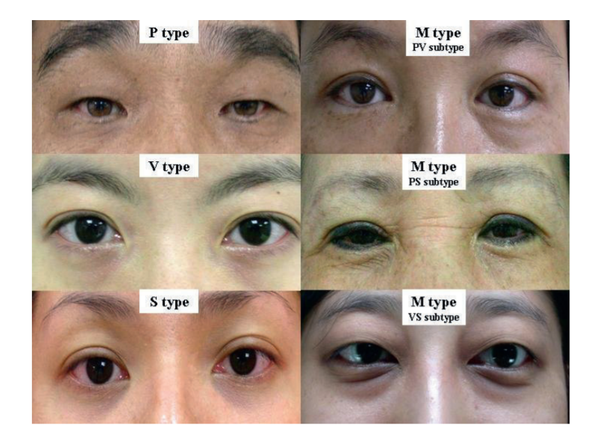 Các Loại Quầng Thâm Mắt