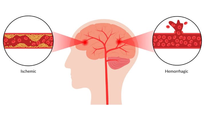 Cerebrovascular Là Gì