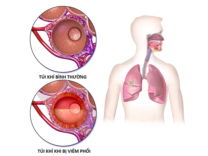 Hay Bị Khó Thở Là Bệnh Gì