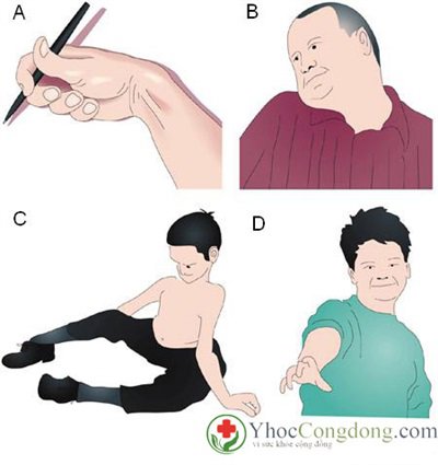 Loạn Trương Lực Cơ