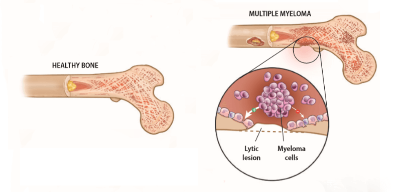 Myeloma Là Gì