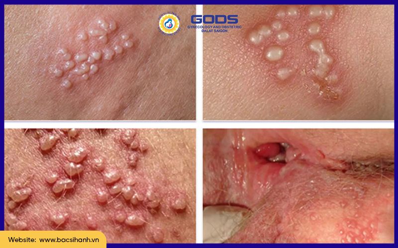 Triệu Chứng Mụn Rộp Sinh Dục