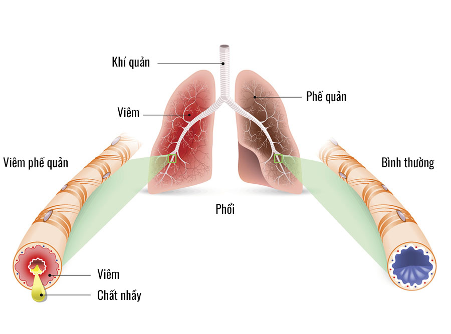Vieêm Phế Quản