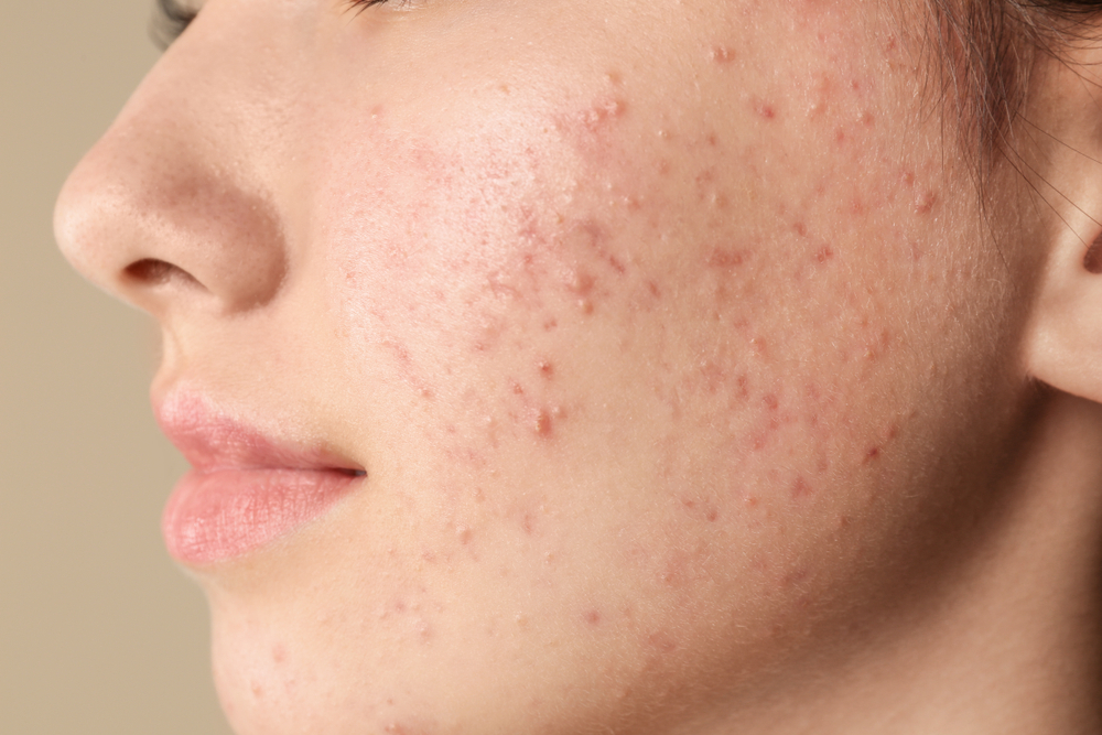 Acne Prone Skin Là Gì