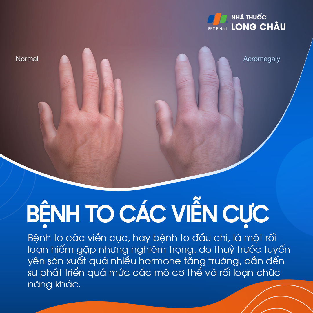 Acromegaly Là Gì
