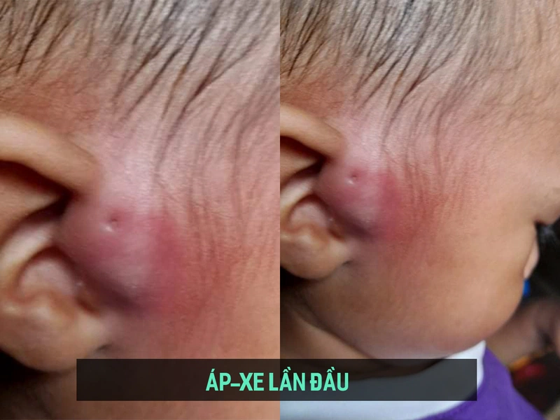 áp Xe Rò Luân Nhĩ