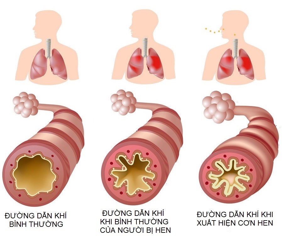 Asthma Là Bệnh Gì