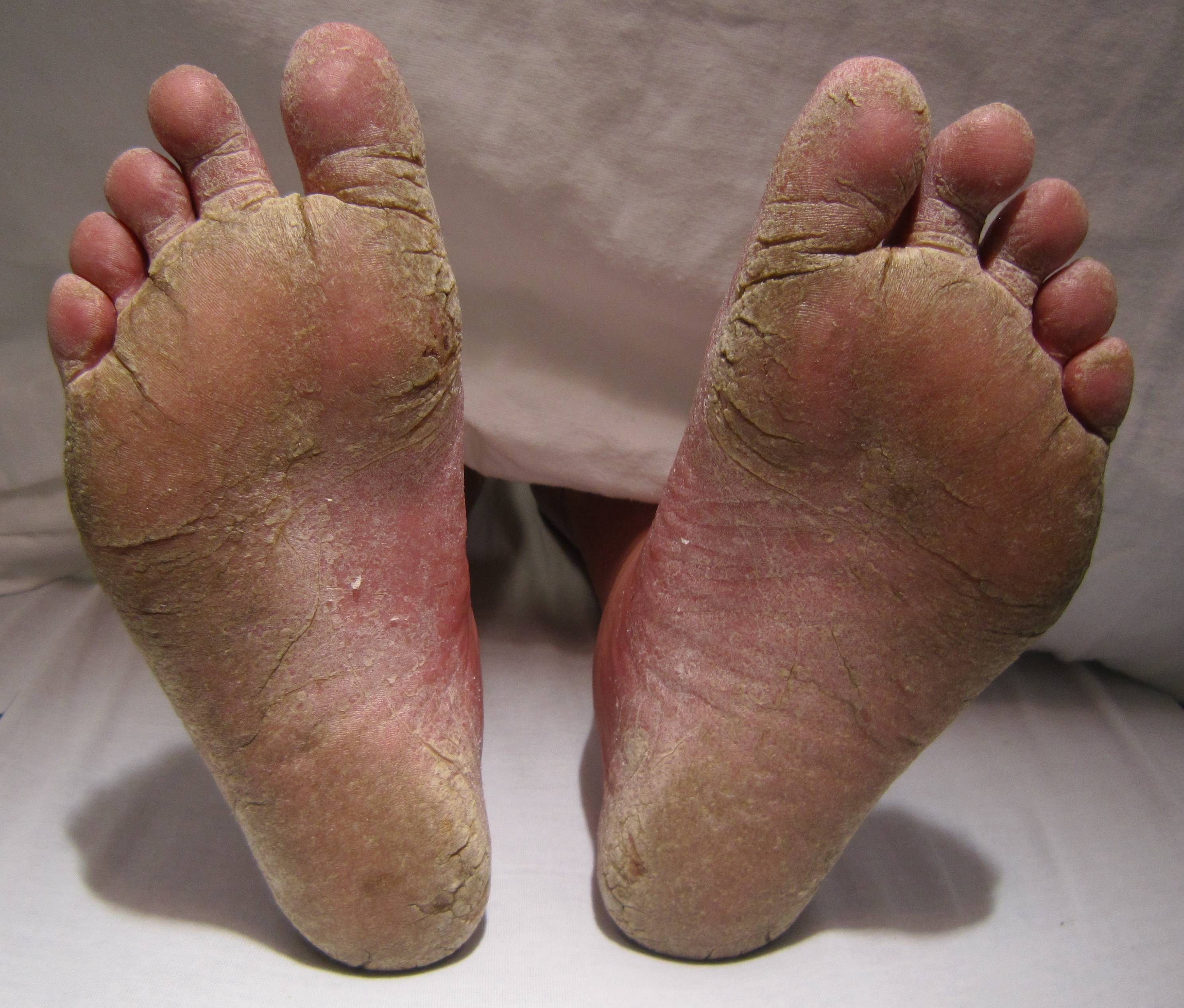 Athlete's Foot Là Gì
