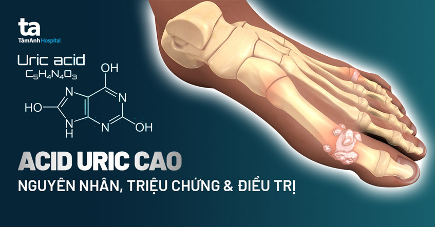 Axit Uric Trong Máu Cao