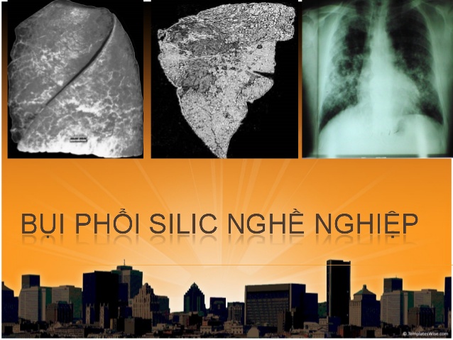 Bệnh Bụi Phổi Silic
