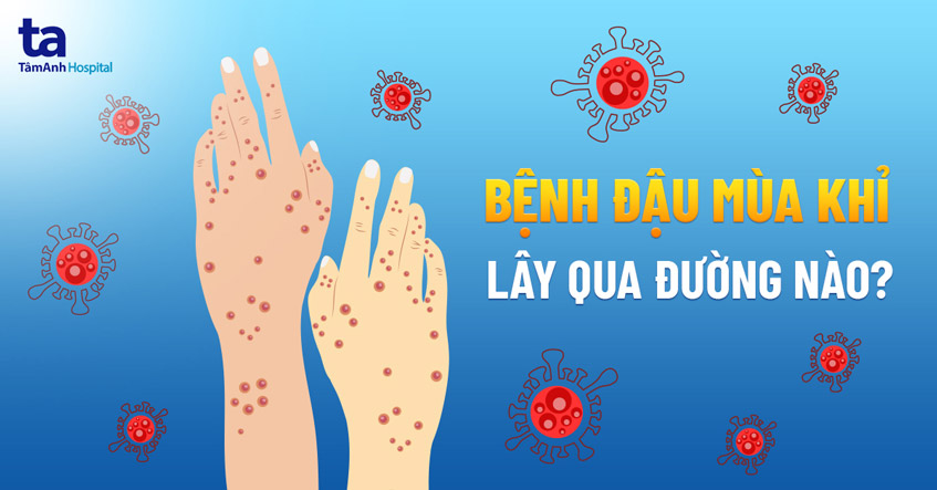 Bệnh đậu Mùa Khỉ Lây Qua đường Nào