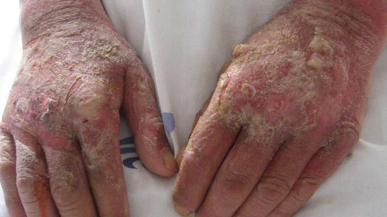 Bệnh Pellagra Là Bệnh Gì