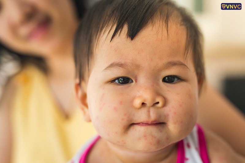 Bệnh Rubella O Tre Em