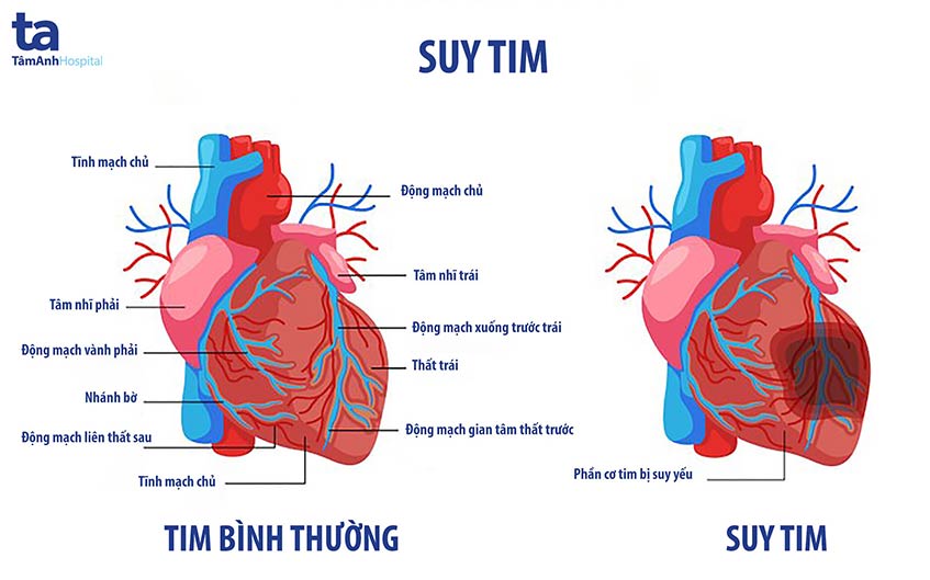 Bệnh Suy Tim Là Gì
