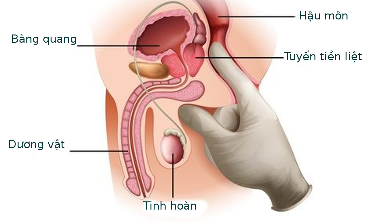 Bệnh Tuyến Tiền Liệt Là Gì