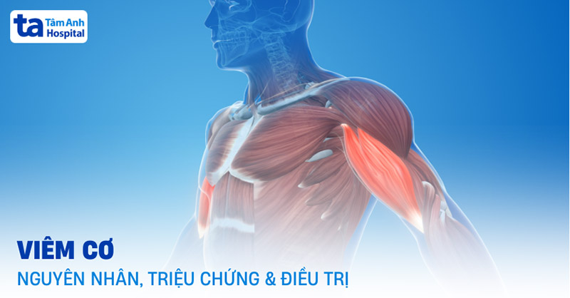 Bệnh Viêm Cơ