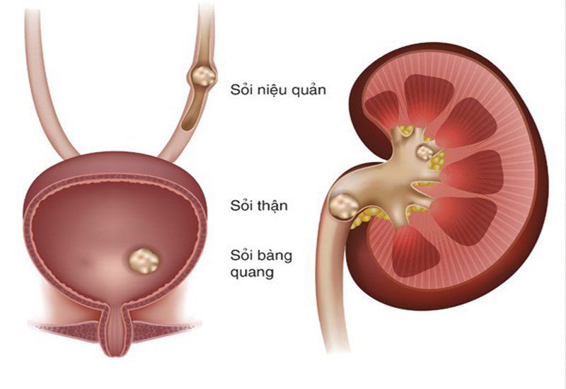 Bệnh Xốp Tủy Thận
