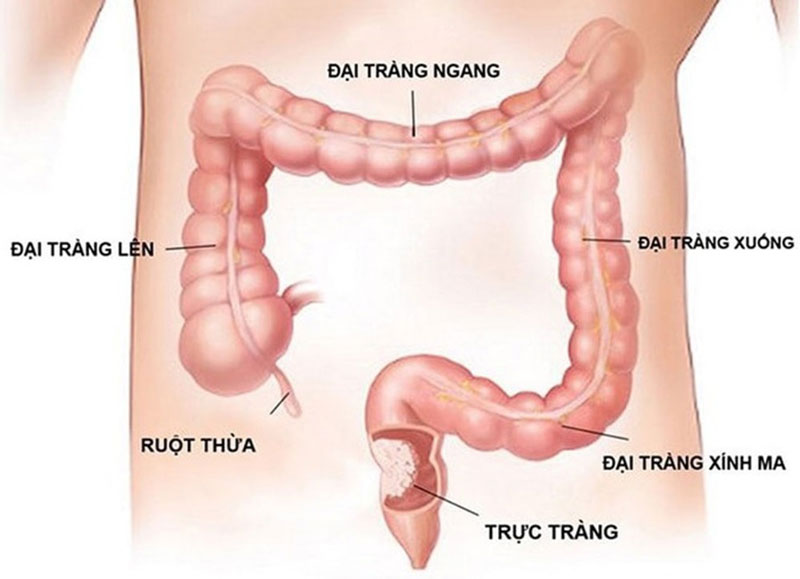 Bị đau đại Tràng