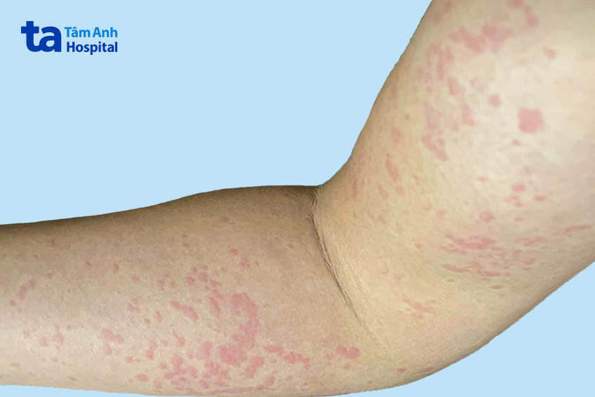 Bị Nổi Mề đay Thường Xuyên