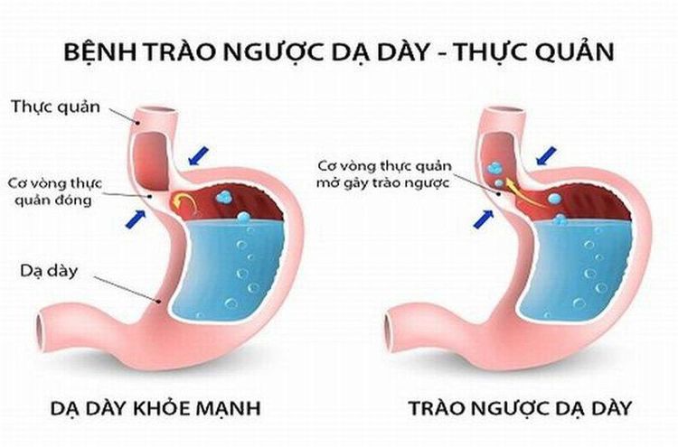 Bị Trớ Là Gì