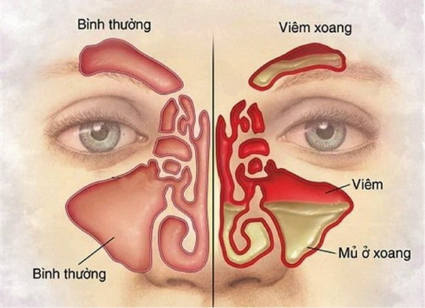 Bị Viêm Mũi