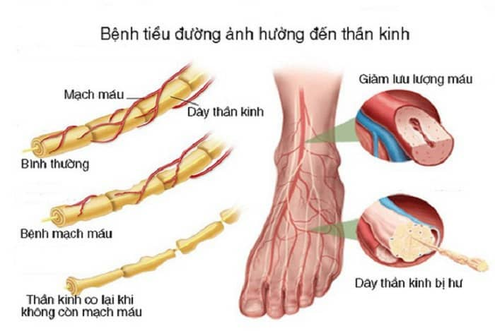 Biến Chứng Thần Kinh Của Bệnh Tiểu đường