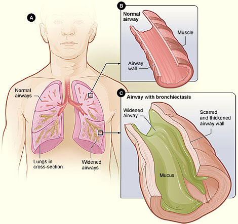 Bronchiectasis Là Gì