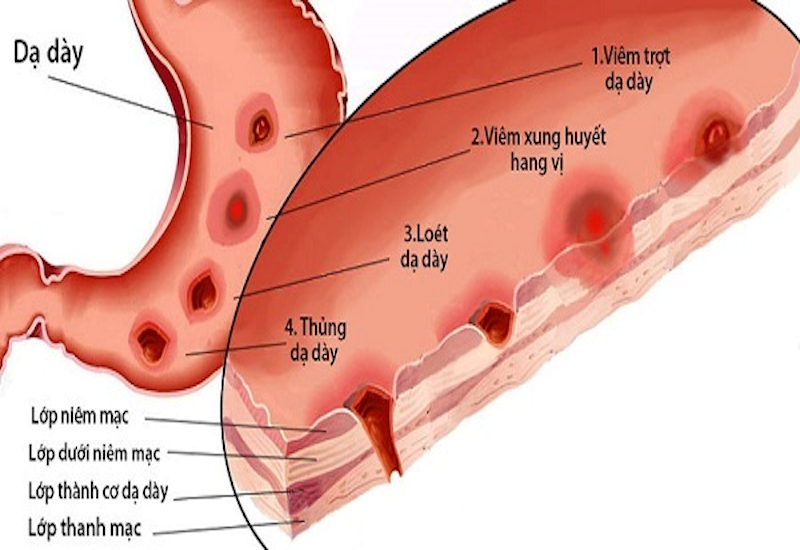 Bục Dạ Dày