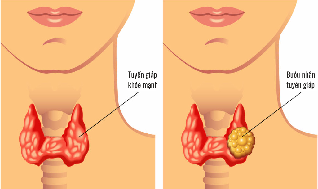 Bướu Nhân Tuyến Giáp