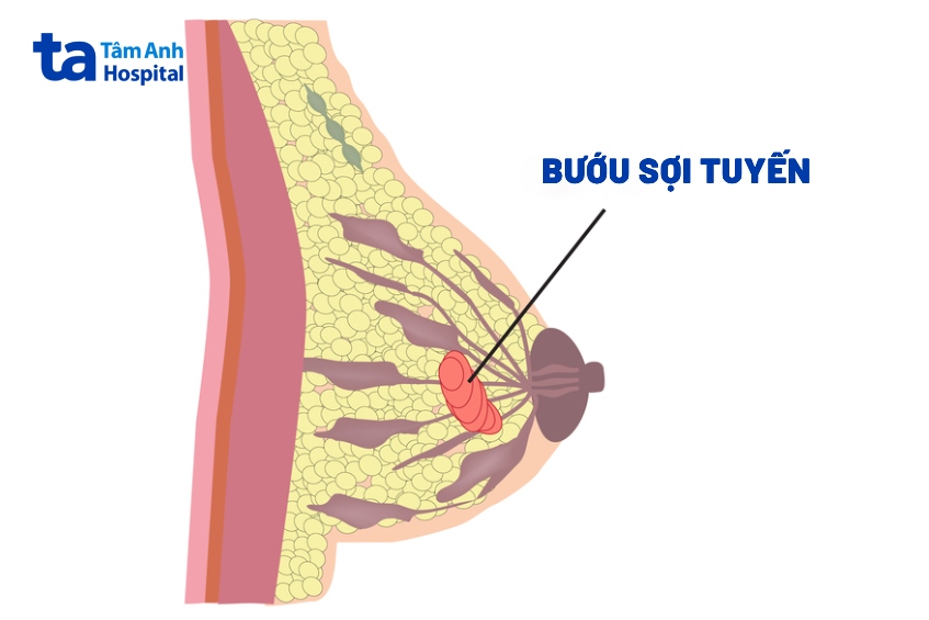 Bướu Sợi Tuyến Vú Birads 3