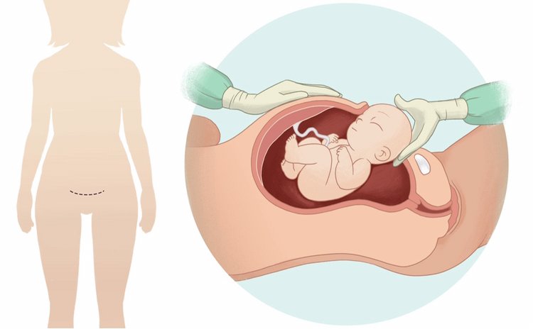 C Section Là Gì