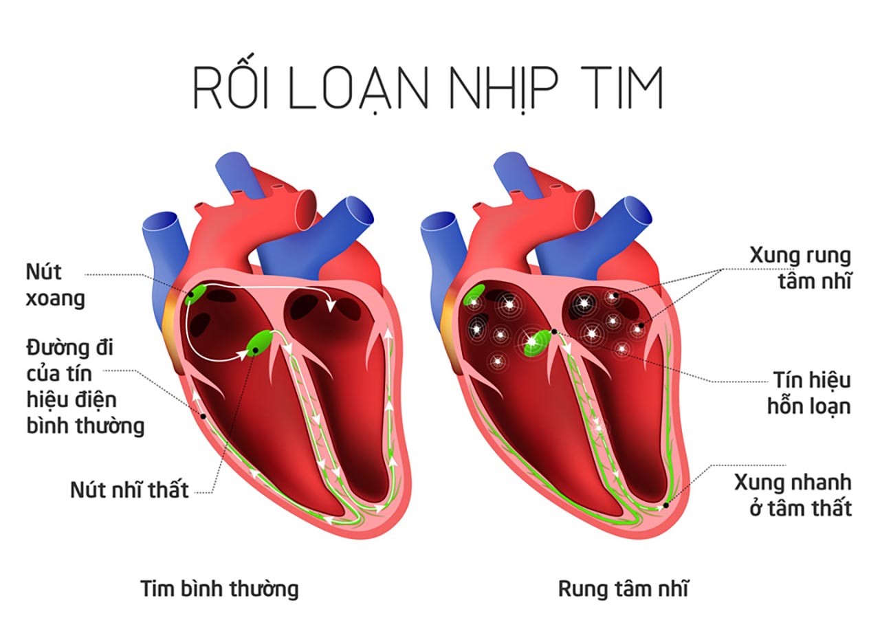 Các Loại Bệnh Tim