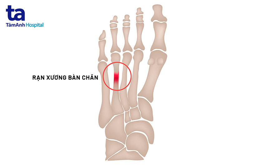 Cách Chữa Rạn Xương