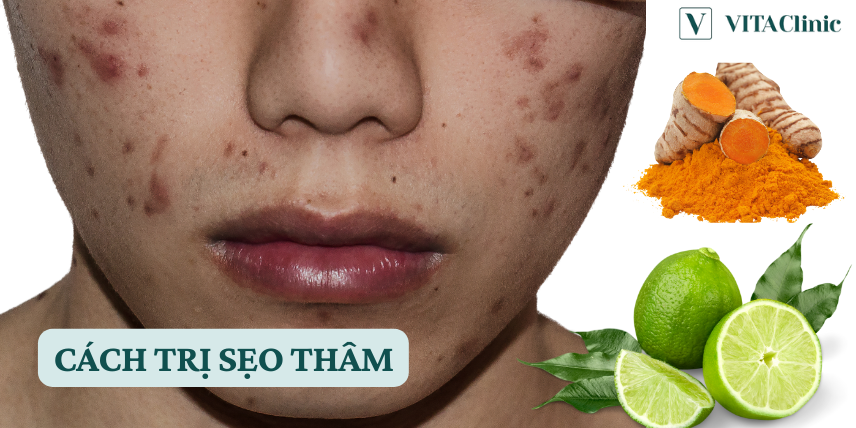 Cách Trị Thâm Sẹo