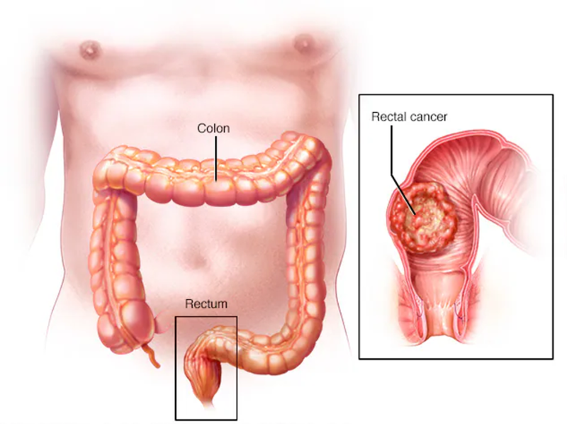 Carcinoma Tuyến Biệt Hóa Vừa Trực Tràng